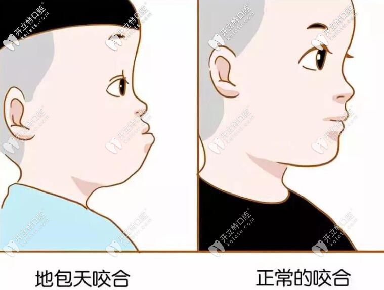 孩子牙齒地包天要盡早矯正 孩子牙齒地包天要盡早矯正