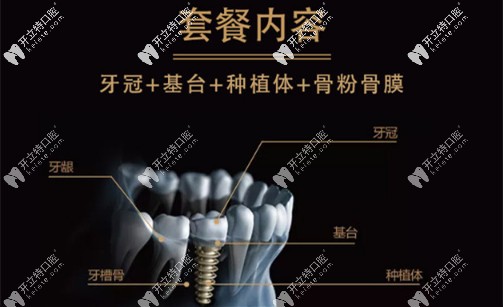 瑞典諾貝爾pmc套餐價(jià)內(nèi)容