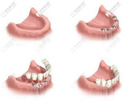適合做種植牙的人群