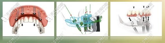 北京做allon4速導(dǎo)半口種植牙的費用