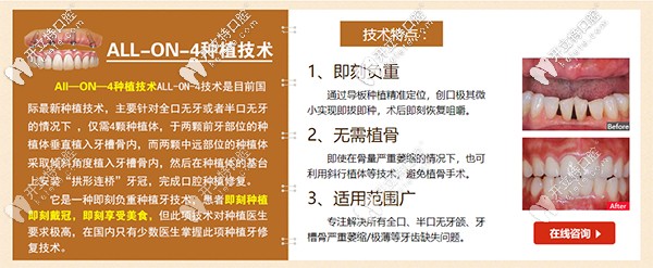 All-on-4速導(dǎo)半口種植牙特點