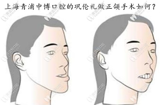 誰知道上海中博口腔做地包天正頜手術(shù)的醫(yī)生是誰？