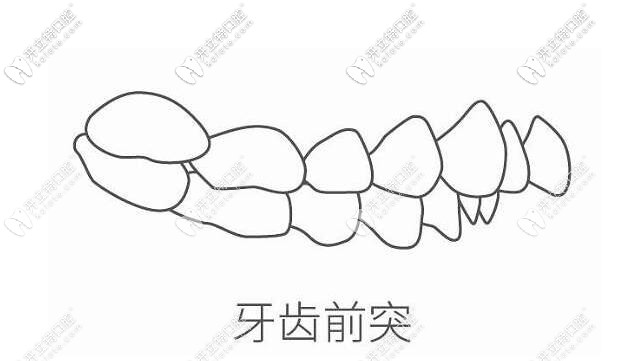 牙齒前突