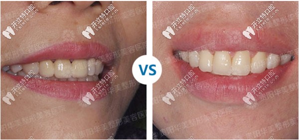 貴陽(yáng)華美口腔牙齒矯正案例