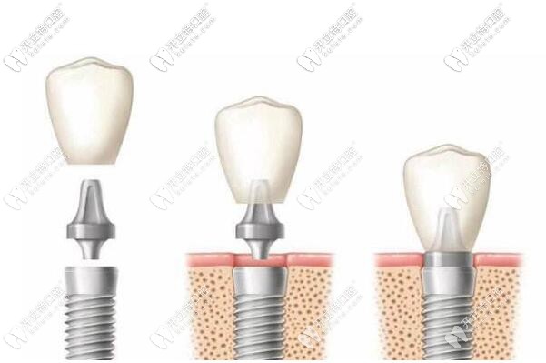 進口種植牙系統(tǒng)