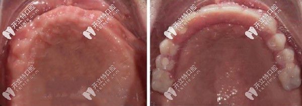ALL-ON-4半固定種植前后對比照