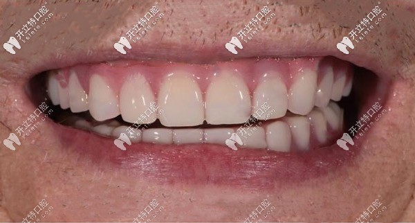 全口種植牙種植牙后