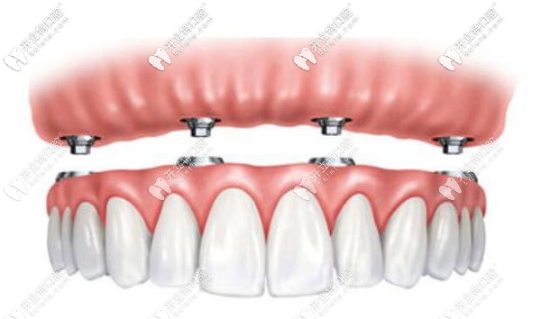 半固定種植圖示