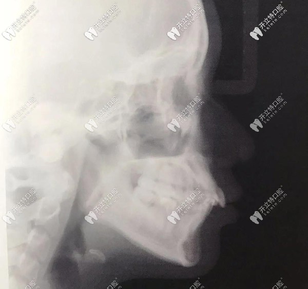 側(cè)面X光，門(mén)牙唇傾很厲害的