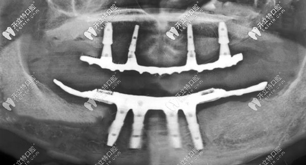 ALL-ON-4種植X線片
