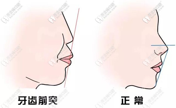 通過整牙可以改變嘴凸 通過整牙可以改變嘴凸