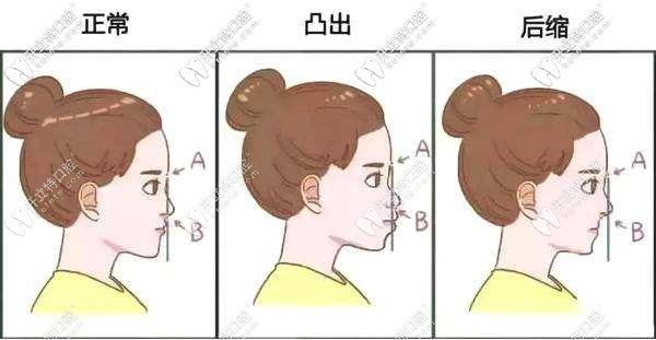 石家莊牙齒矯正價目表(附石家莊嘴凸/地包天/舌側(cè)矯正費用)