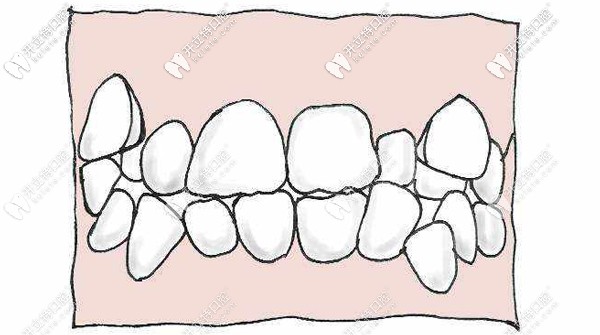 牙齒重度擁擠不齊示意圖