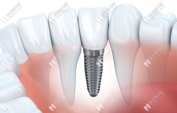 廣州白云區(qū)及天河區(qū)等種牙醫(yī)院排名單
