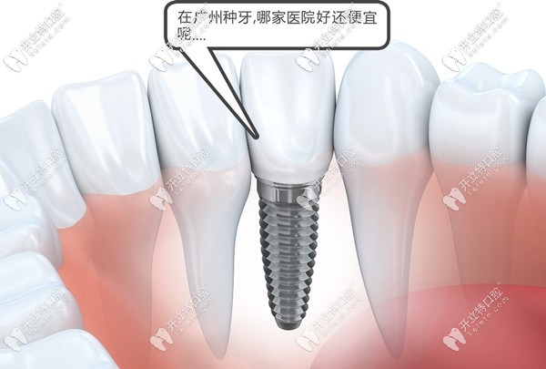 關(guān)于廣州哪家醫(yī)院做種植牙的價(jià)格便宜又好,都在此攻略