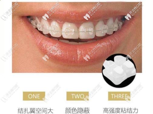 半隱形矯正特色