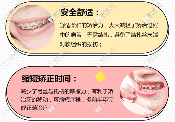 金屬自鎖鋼絲牙套矯正