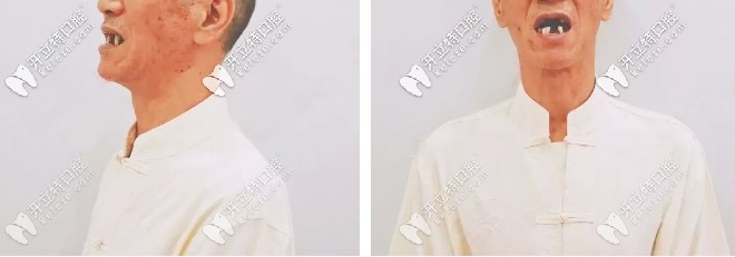 廣州廣大口腔80歲老人在廣州越秀區(qū)做瑞典諾貝爾種植牙的真實(shí)感受