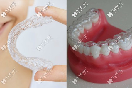 隱形牙套外觀