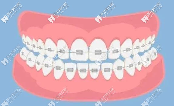 金屬矯正示意圖