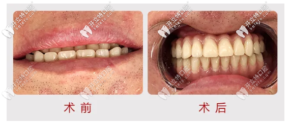 廈門(mén)麥芽口腔,諾貝爾allon6半口種植牙讓你缺牙重生案例展示