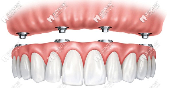 all-on-4半口即刻種植