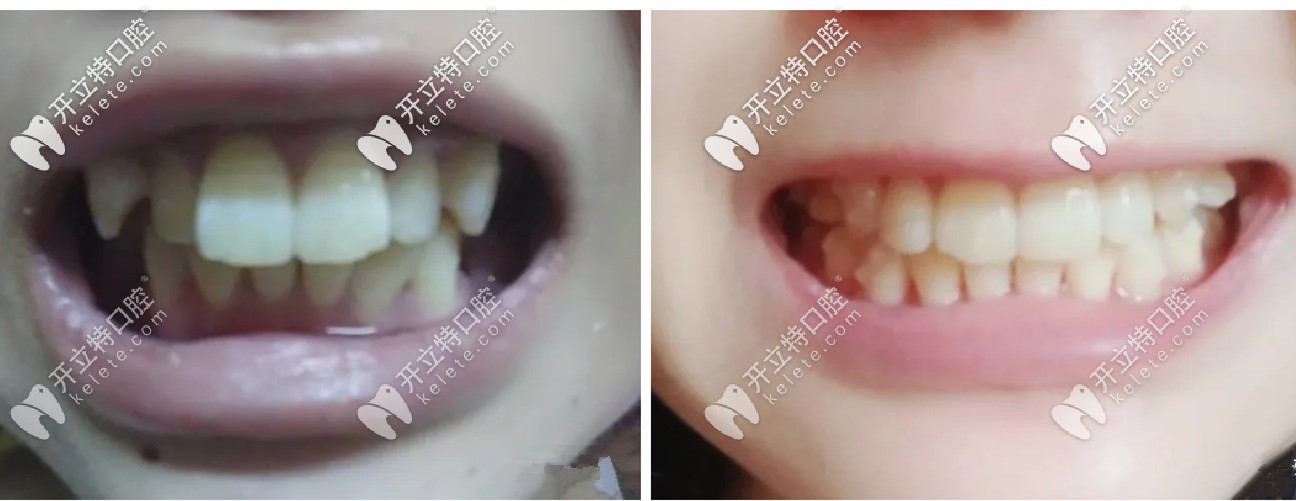 一年半的時(shí)間，牙套已經(jīng)變得<span style=