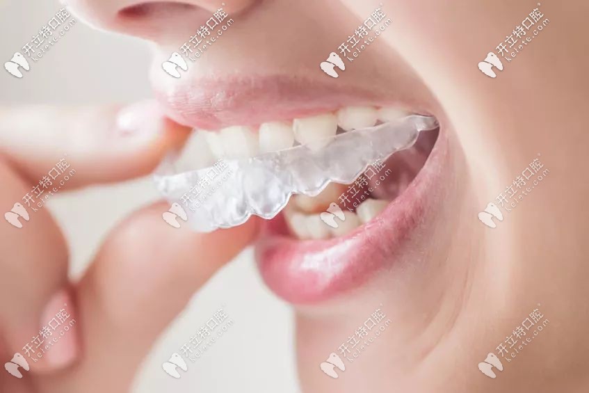 隱形矯正牙套
