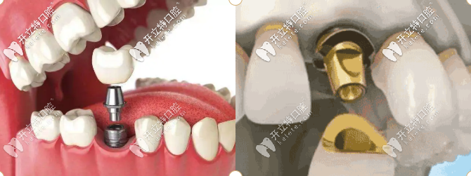 種植牙是你的第三幅牙齒