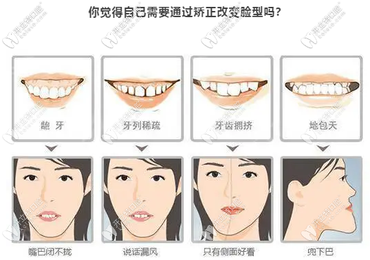 看看自己需要通過整牙來改變臉型嗎