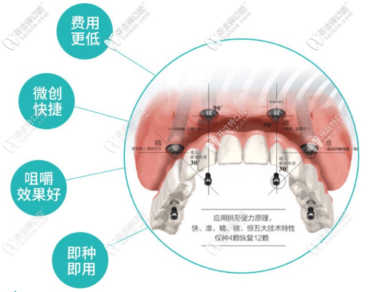 成都團圓口腔做韓國登騰半口即刻負重種植牙的價格上線啦