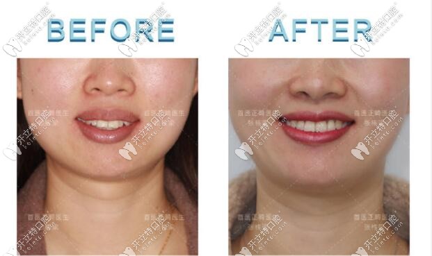 骨性I類齙牙小姐姐矯正正臉<span style=