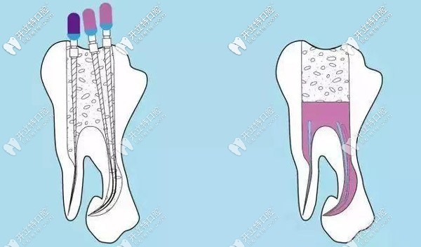 根管治療的步驟