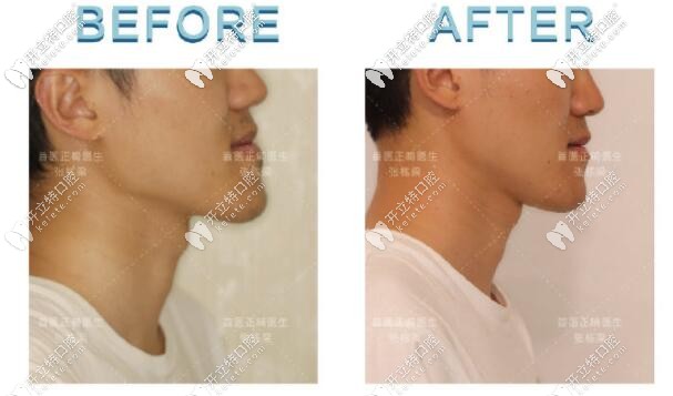 骨性III類地包天小哥哥，矯正后側(cè)臉對比圖