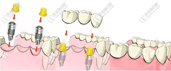 種植牙的組成過程