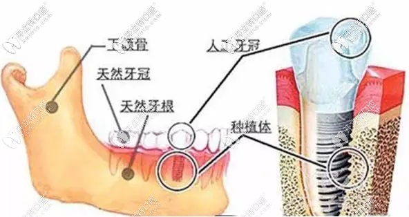 還在問(wèn)西寧做一顆種植牙需要多少錢(qián)?這份收費(fèi)清單你沒(méi)看吧