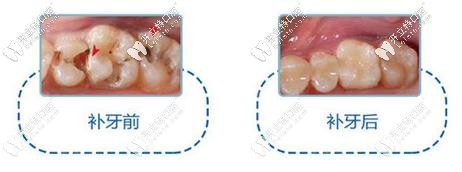 補牙前后對比