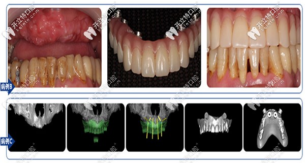 沈陽盛大口腔全口、半口缺失案例