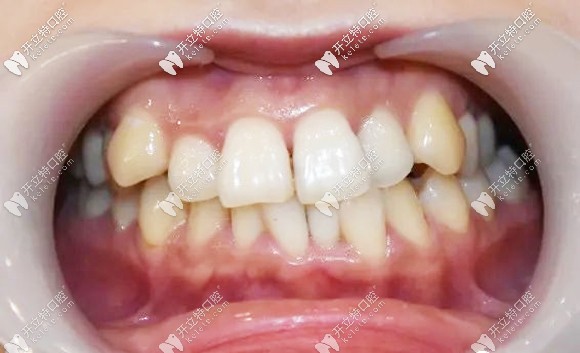 近距離的牙齒正面照 近距離的牙齒正面照