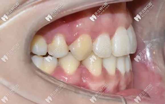 矯正后的牙齒側(cè)面效果圖 矯正后的牙齒側(cè)面效果圖