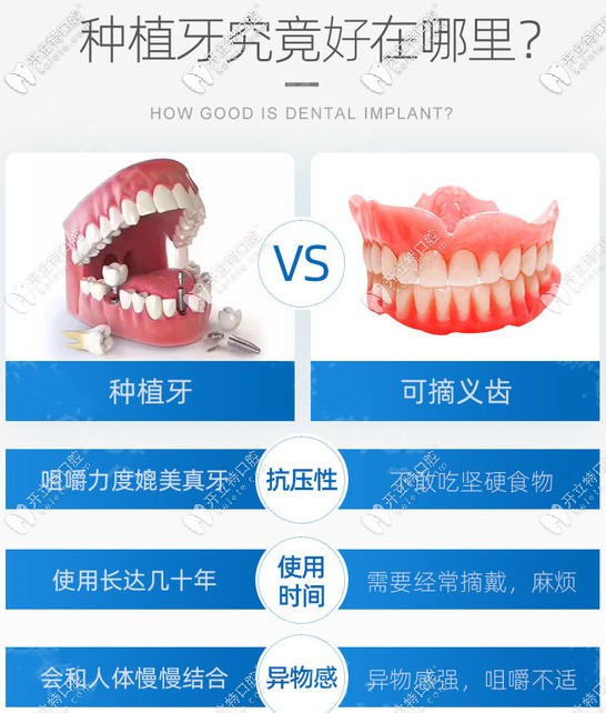 活動假牙VS種植牙