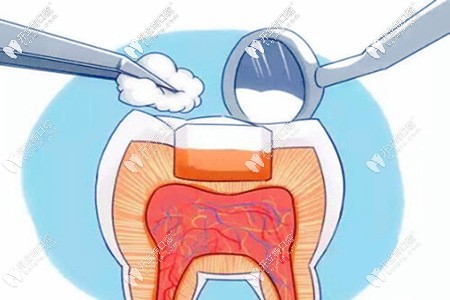 你關(guān)注的可樂麗菲露樹脂補牙多少錢一顆來了,附優(yōu)缺點哦