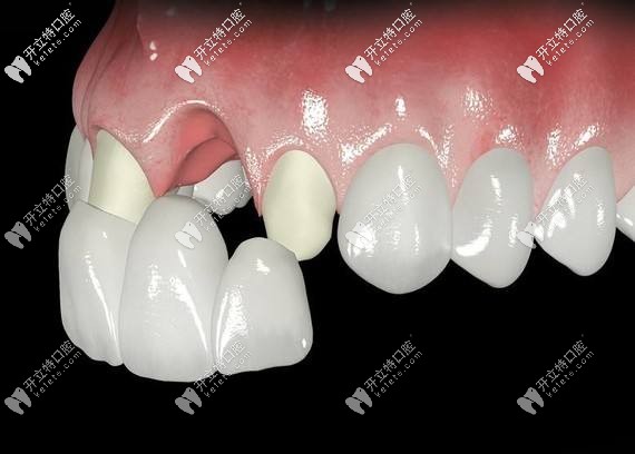 全瓷牙套的壽命是幾年?能用一輩子嗎？