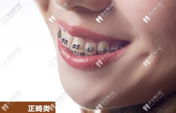 牙齒矯正優(yōu)惠