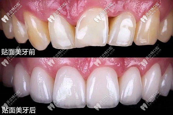 超薄瓷貼面修復前后效果