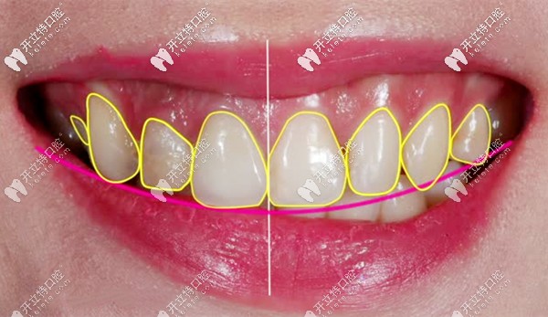 牙齒貼面的方案設計圖