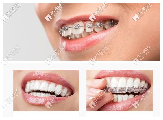 金屬牙套和隱形牙套
