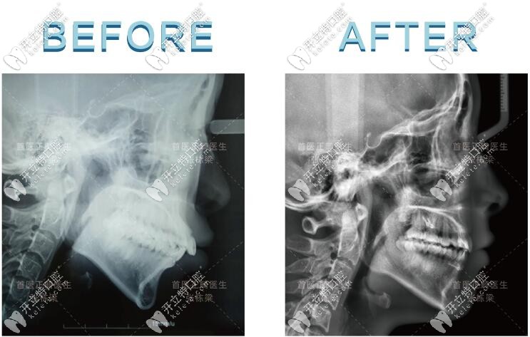 張棟梁做過的骨性齙牙病例對(duì)比圖