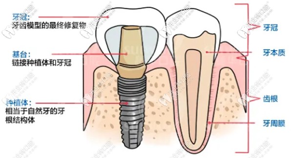 廣州穗華口腔的半口全固定種植牙價(jià)格超劃算