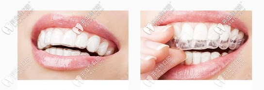 隱形牙套的效果